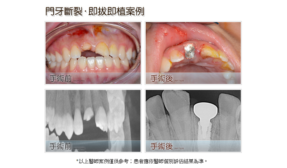 門牙斷裂．即拔即植案例