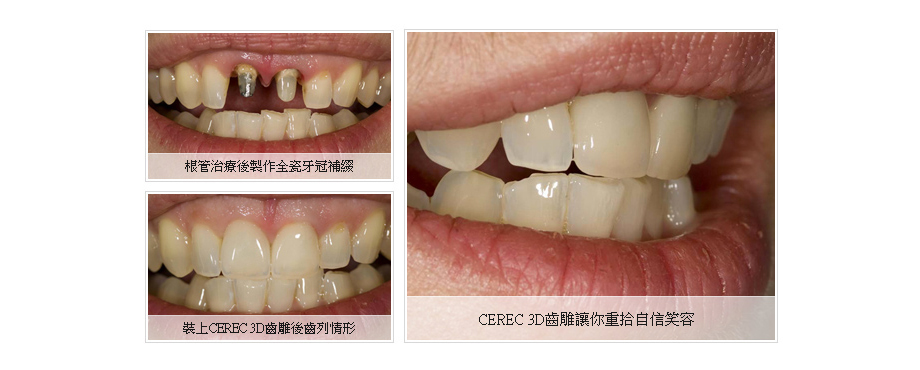 3D科技植牙過程