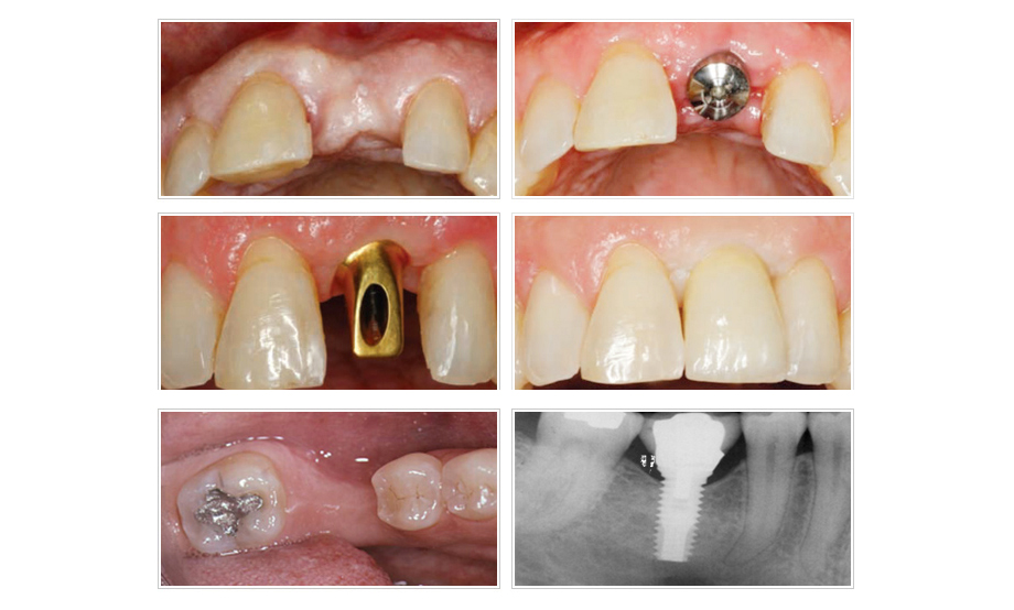 3D科技植牙案例過程