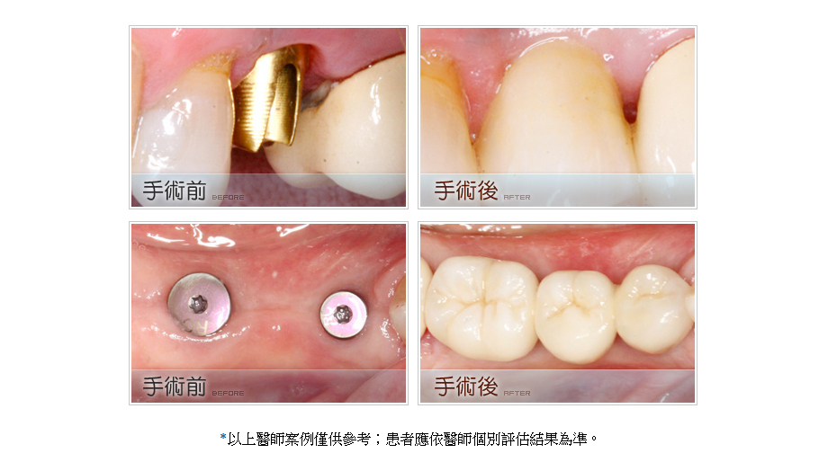 3D科技植牙案例前後2