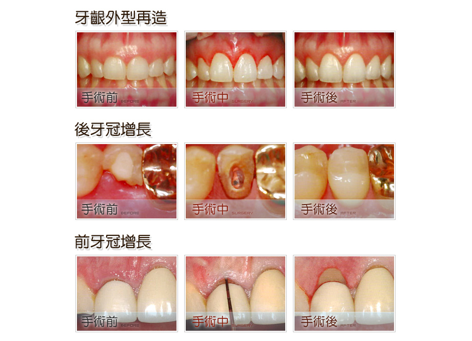 牙齦外型再造．牙冠增長術前後