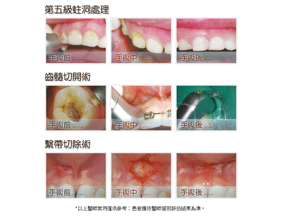 蛀牙手術前後