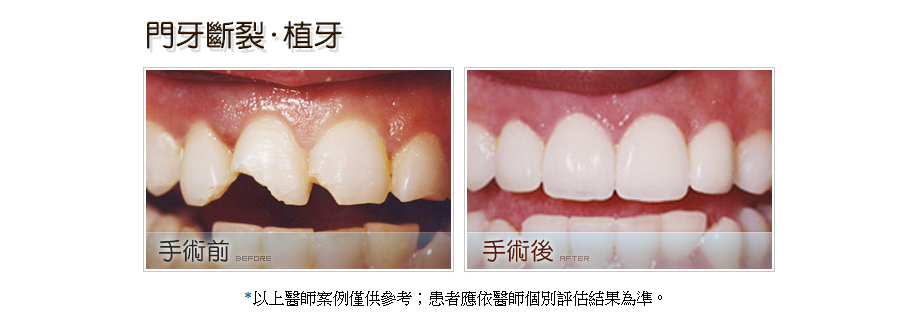 門牙斷裂植牙前後