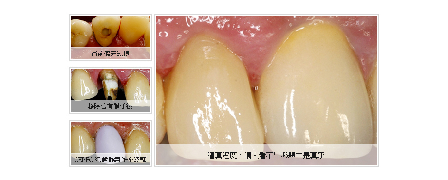3D齒雕植牙逼真分不出真假