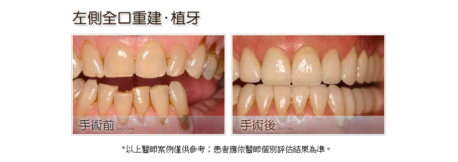 左側全口重建植牙前後
