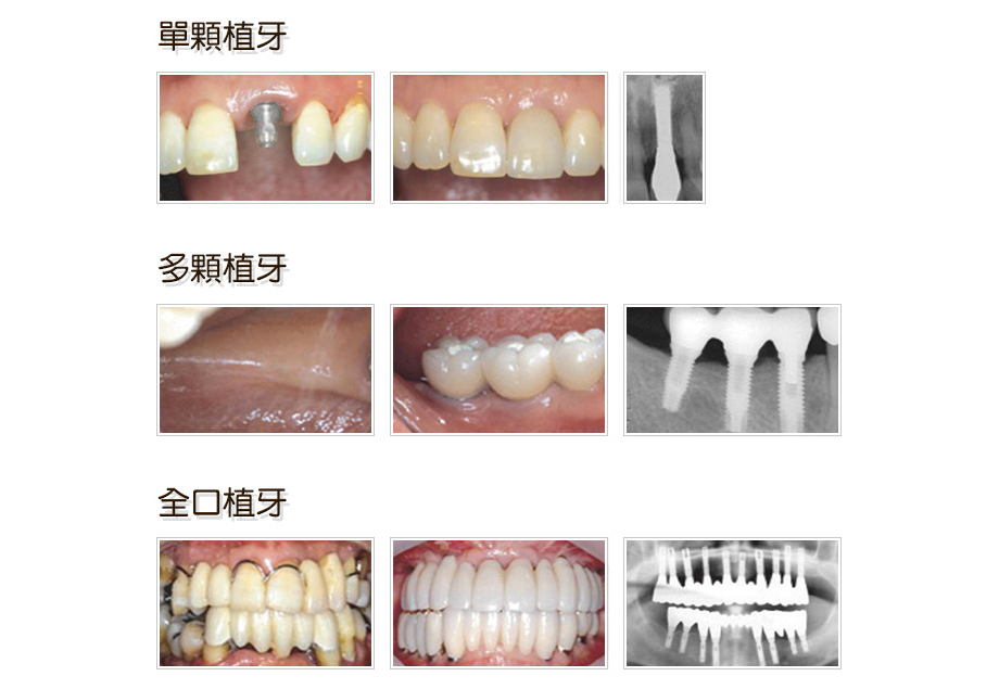 複合式全口3D植牙