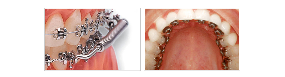 牙齒矯正器種類