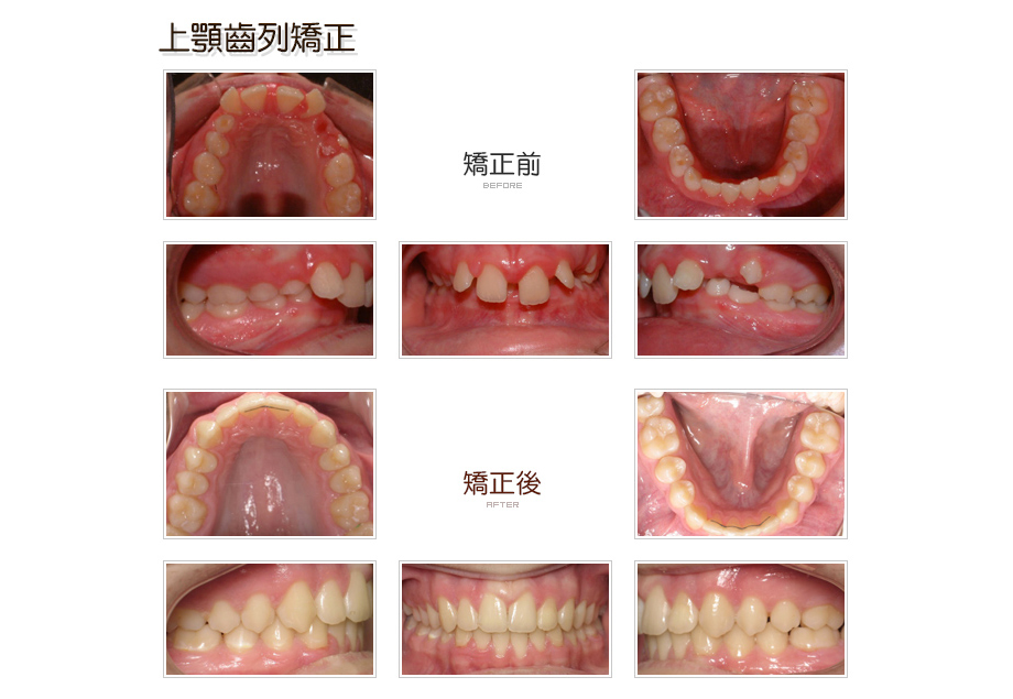 上顎齒列牙齒矯正前後