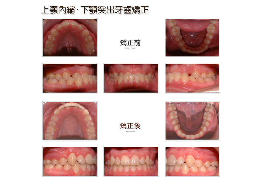 上顎內縮．下顎突出的牙齒矯正前後