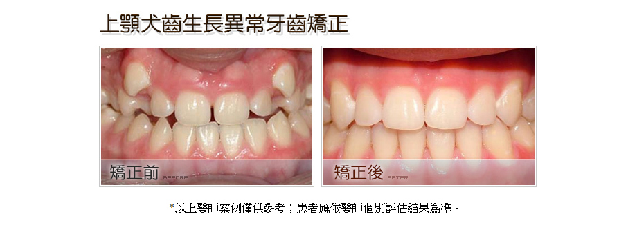 上顎犬齒生長異常牙齒矯正前後