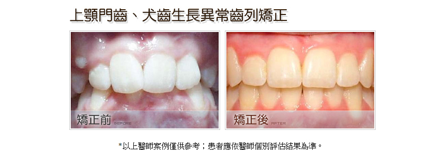 上顎門齒、犬齒生長異常齒列矯正前後