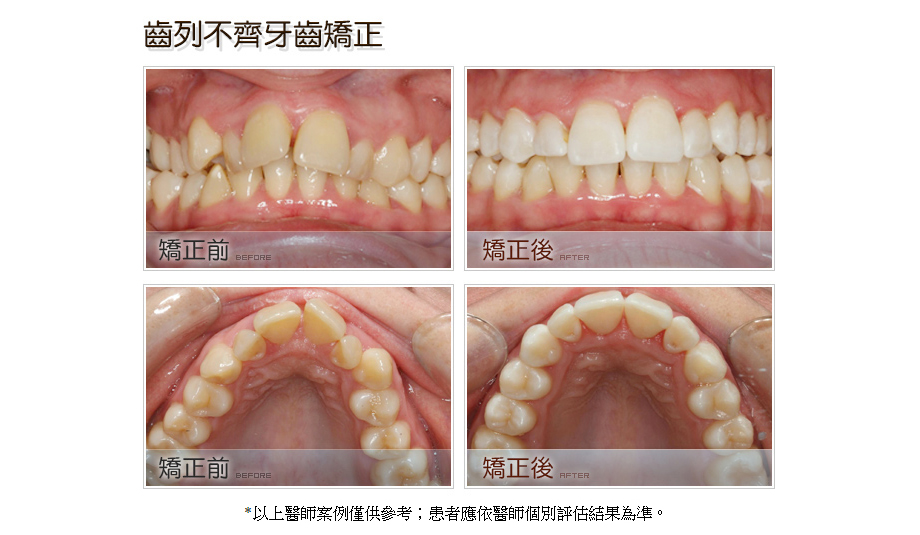 齒列不齊牙齒矯正前後