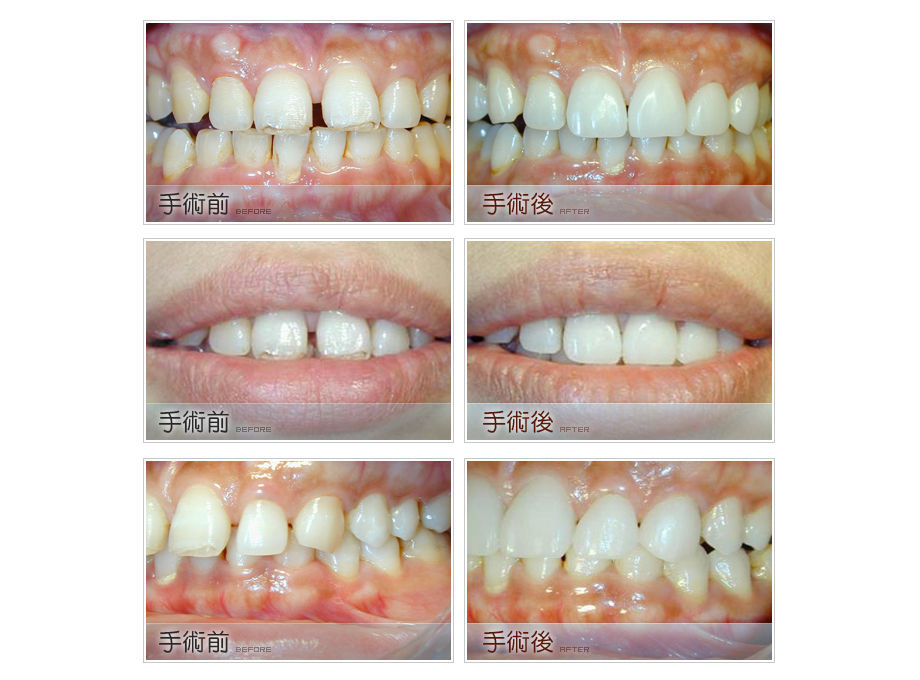 咬合不正的牙齒矯正治療前後