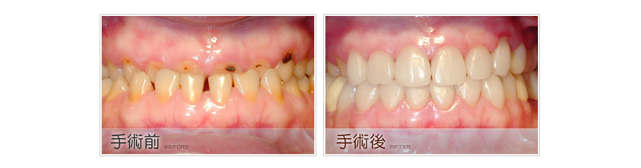 咬合不正的牙齒矯正治療前後2