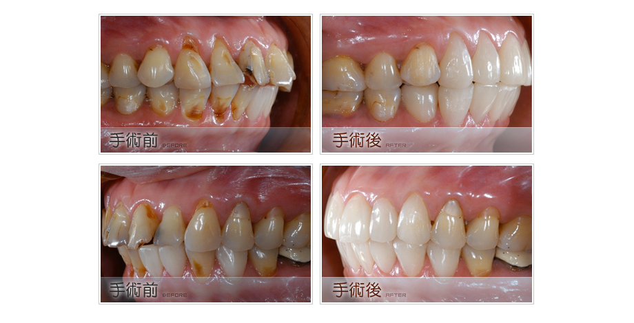 咬合不正的牙齒矯正治療前後3
