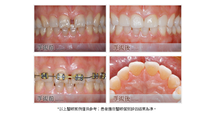 牙齒矯正治療前後