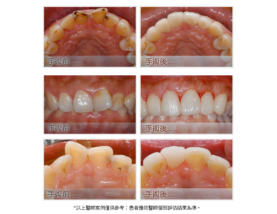 牙齒矯正治療前後2