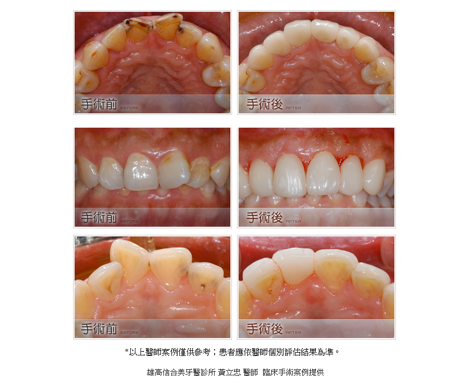 牙齒矯正治療前後3