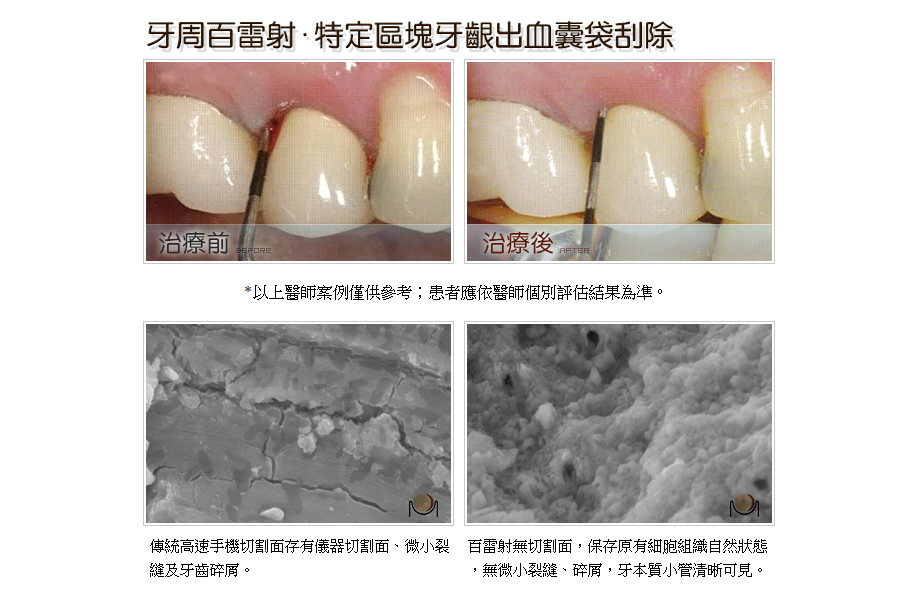 牙周病百雷射．特定區塊牙齦出血囊袋刮除