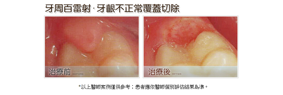 牙周病百雷射．牙齦不正常覆蓋切除