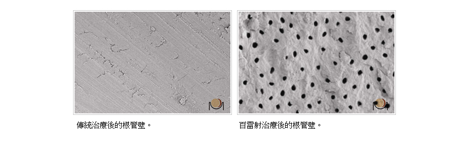 傳統與百雷射治療根管壁比較