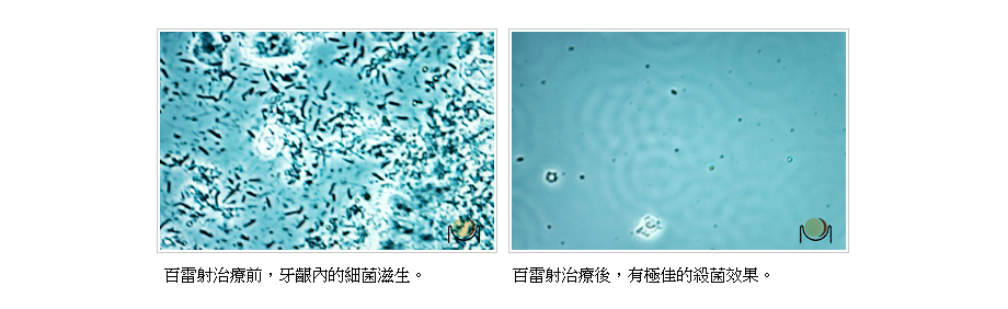 百雷射治療前後的殺菌效果