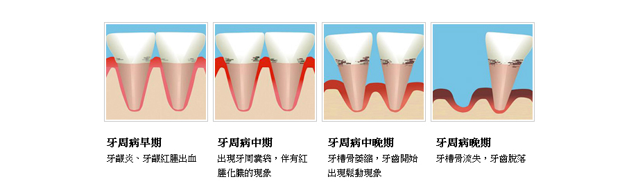 牙周病形成過程
