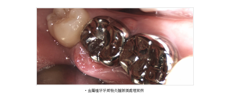 金屬植牙牙周發炎腫脹案例