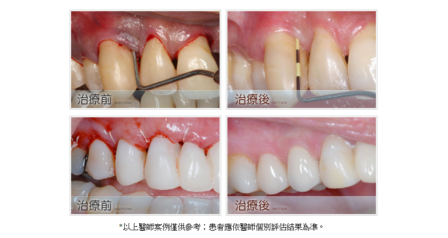 牙周病治療前後