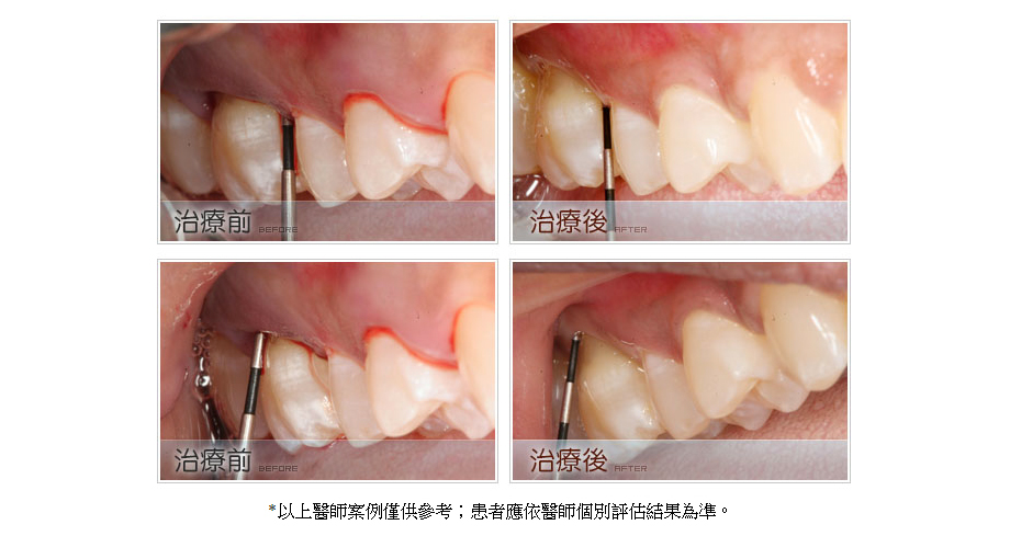 牙周病治療前後3