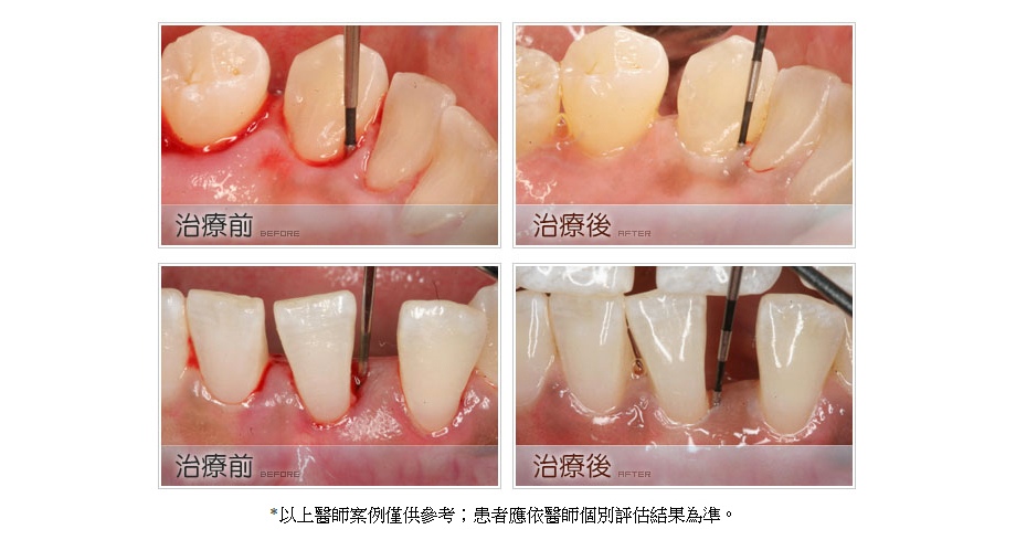 牙周病治療前後4