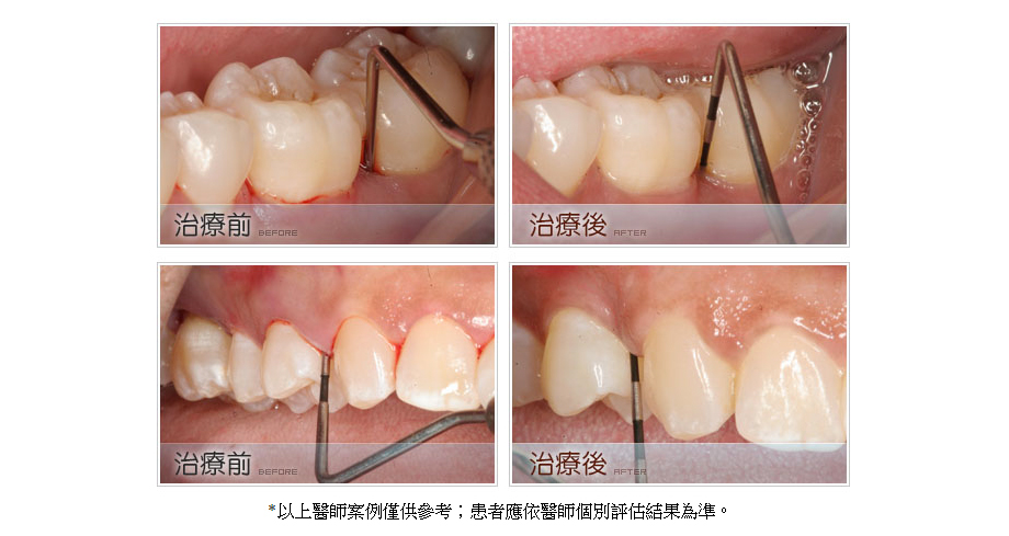 牙周病治療前後5