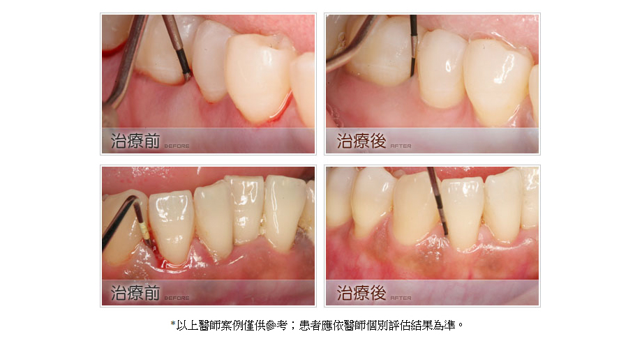 牙周病治療前後6