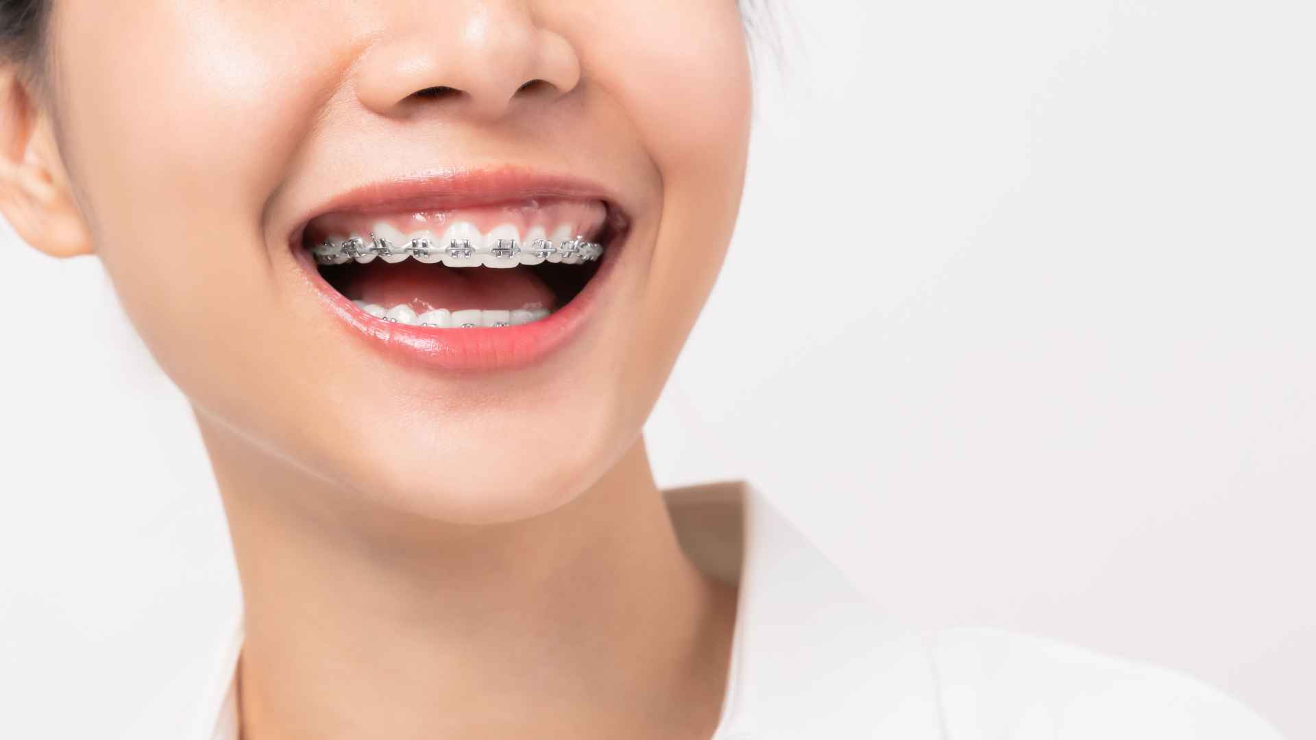 牙齒矯正必要嗎？
